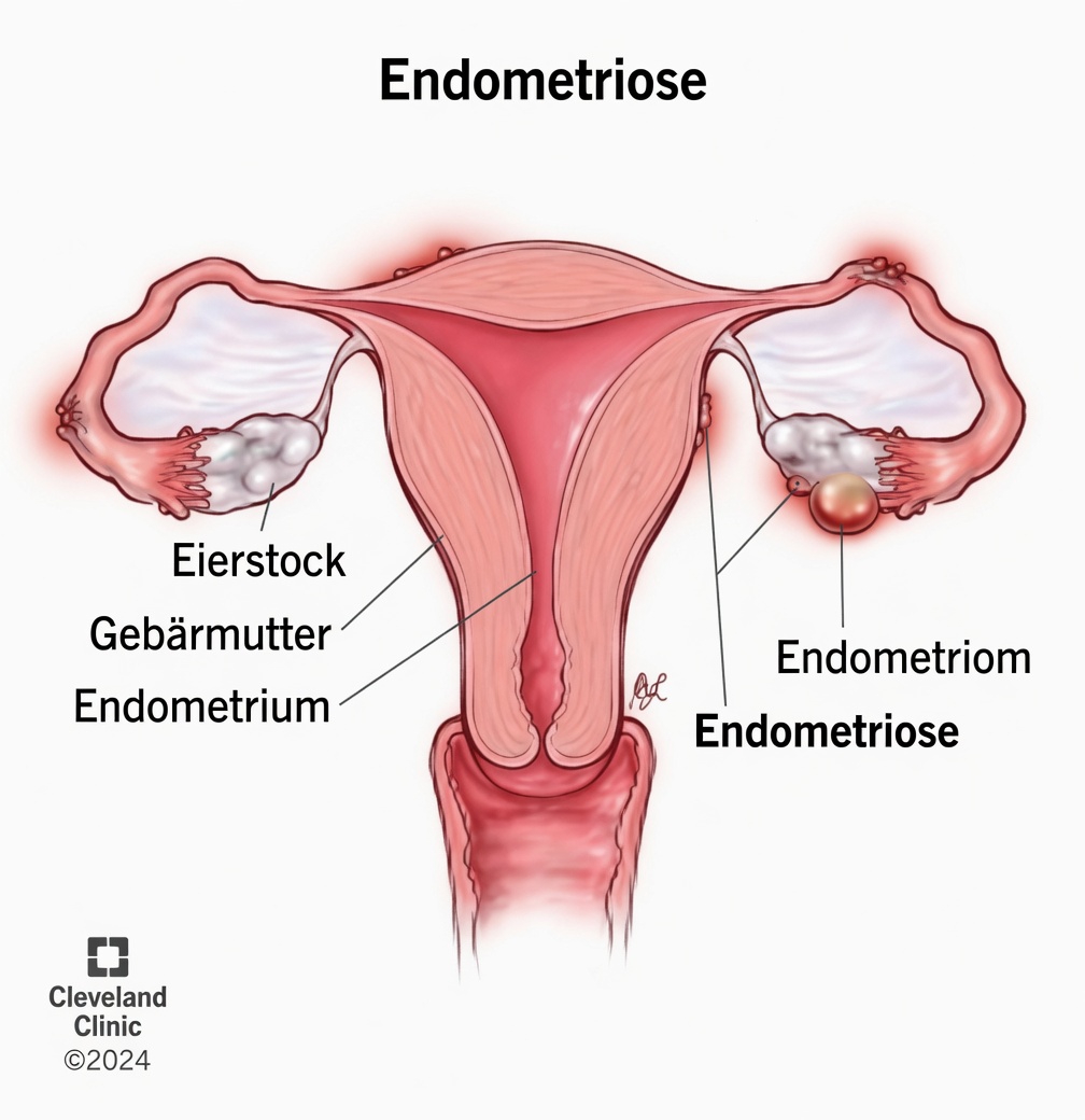 Was ist Endometriose und warum sollte jede Frau darüber Bescheid wissen?