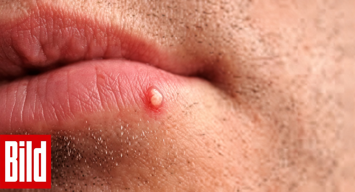 Warum bemerken Menschen ungewöhnliche kleine weiße Beulen an ihren Lippen oder im Intimbereich? Ein einfacher Leitfaden