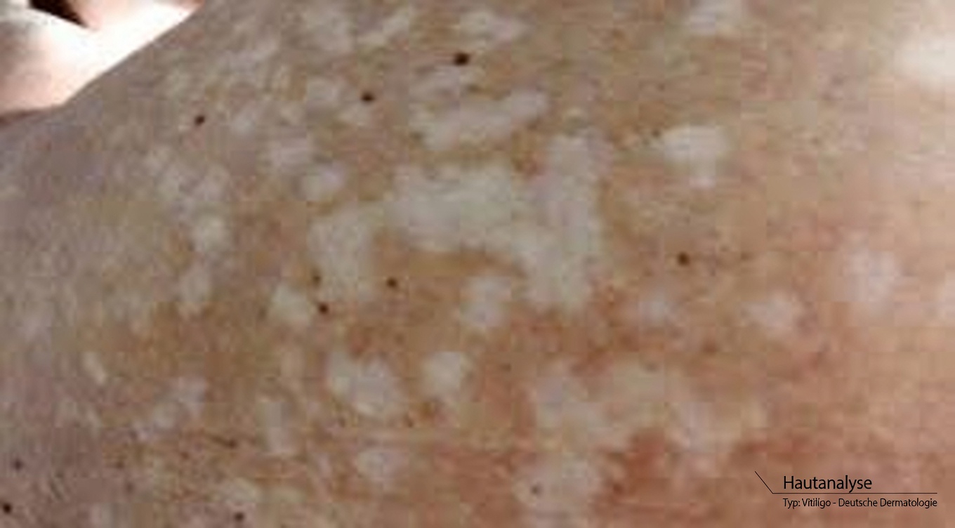 Warum erscheinen kleine weiße Flecken auf Ihren Armen und Beinen? Häufige Hautveränderungen verstehen