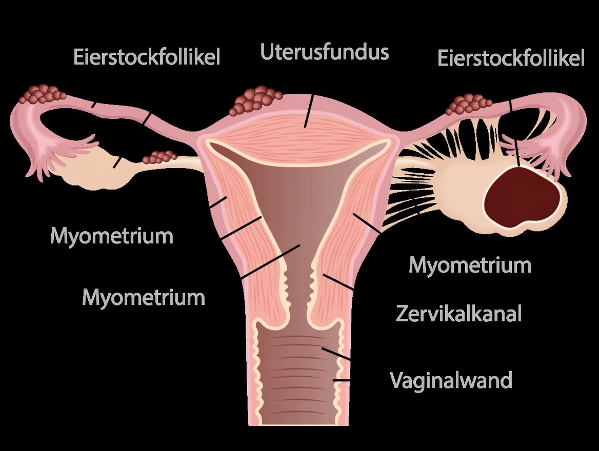 Endometriose-Warnung: Alltägliche Gewohnheiten, die Sie nicht ignorieren sollten