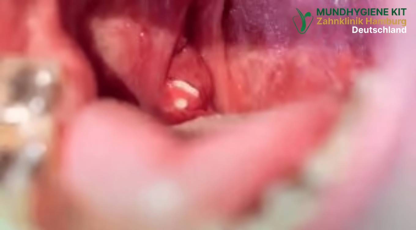 Mandelsteine: Was sie sind und warum sie hinter Ihrem anhaltenden Mundgeruch stecken könnten