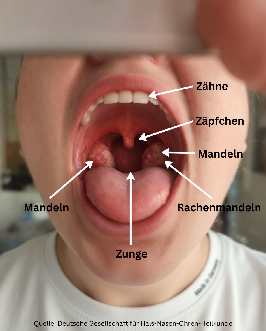 Welche verschiedenen Arten von Halsinfektionen gibt es und wie kann man die Anzeichen frühzeitig erkennen?