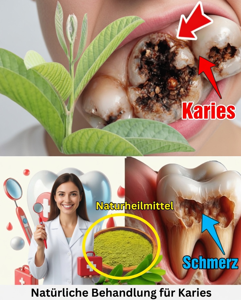 Die 3 besten Möglichkeiten, Karies mit Guavenblättern zu behandeln – einfach und kostengünstig
