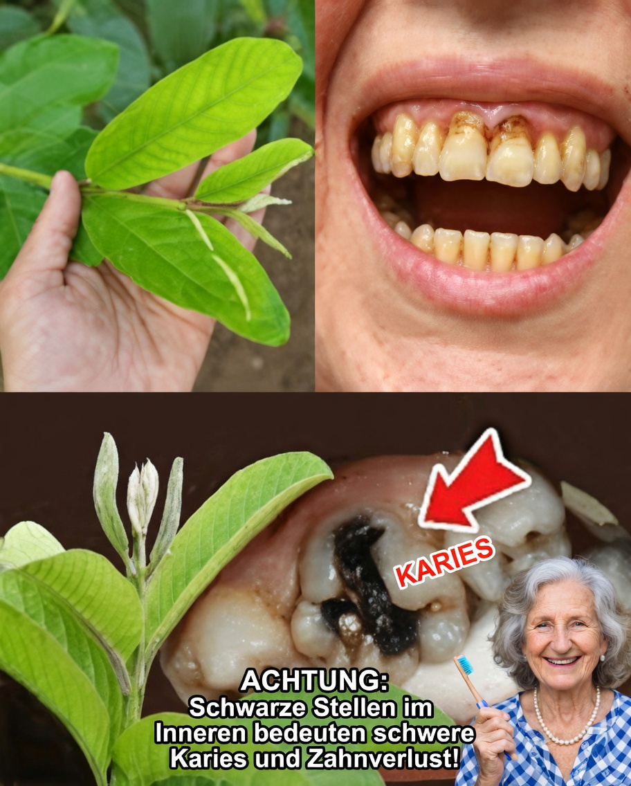 Die 3 besten Möglichkeiten, Karies mit Guavenblättern zu behandeln – einfach und kostengünstig