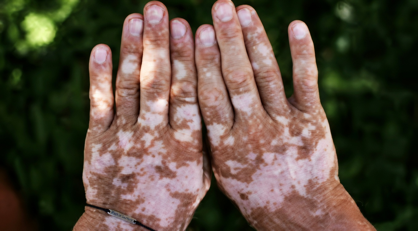 Warum erscheinen kleine weiße Flecken auf Ihren Armen und Beinen? Dieses häufige Hautbild verstehen