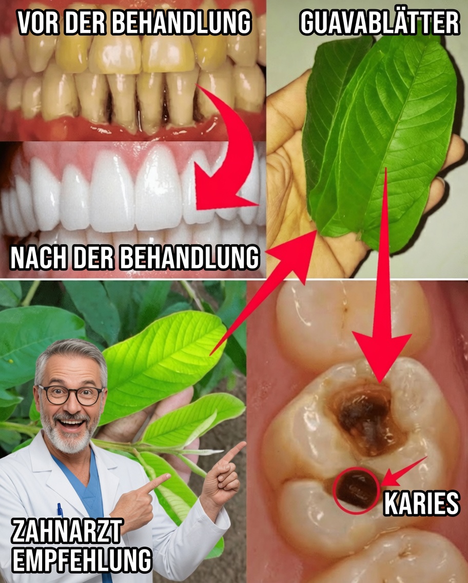 3 Einfache und kostengünstige Möglichkeiten, Karies mit Guavenblättern zu behandeln