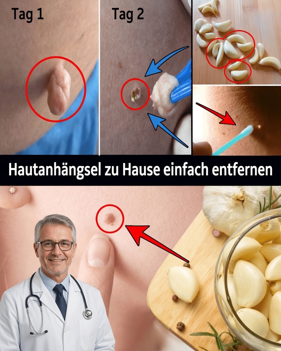 Wie man Hautanhängsel auf natürliche Weise mit Vaseline entfernt: eine einfache Methode über Nacht